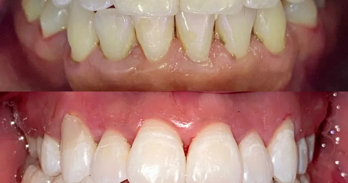 Dentista | Diseño de Sonrisa | Carillas | Brackets | Implantes dentales | CDMX