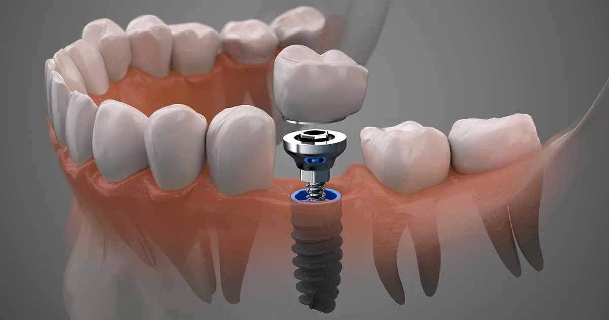 Dentista Urgencias / Brackets /Endodoncia/ Limpieza Dental Blanqueamiento Implantes Protesis Estetica