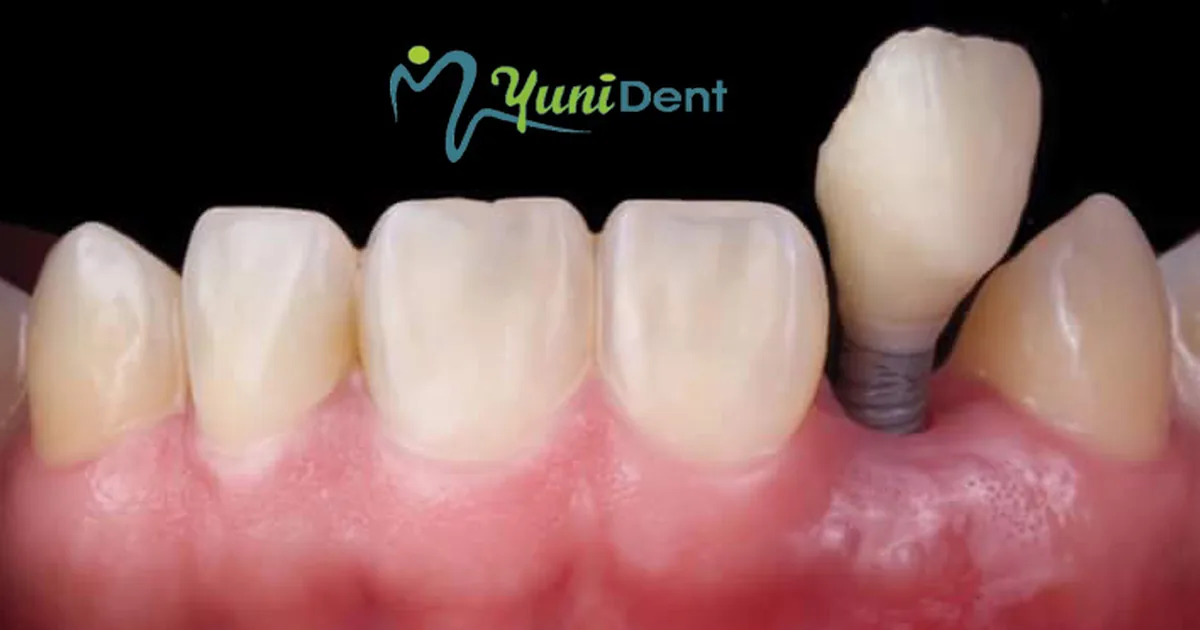 Yunident
