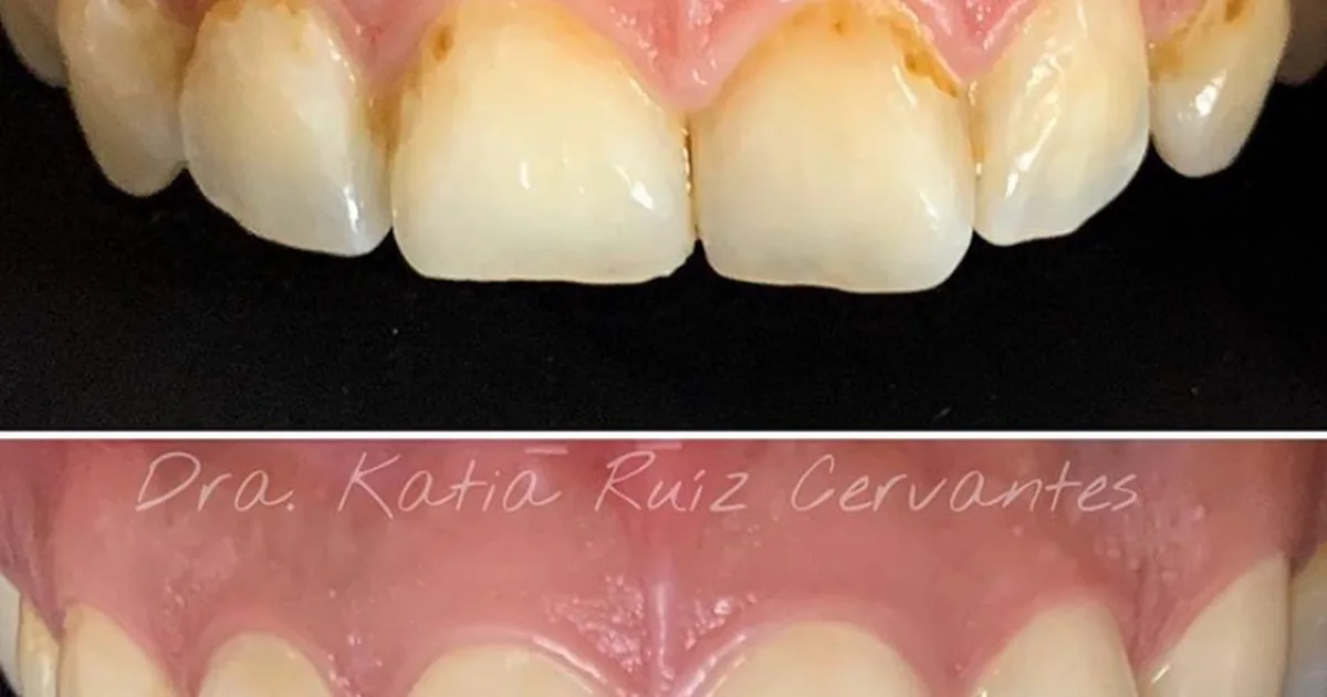 Implantes Dentales Morelia CÉNIT Odontología Avanzada | Dentistas en Morelia | Diseño de Sonrisa